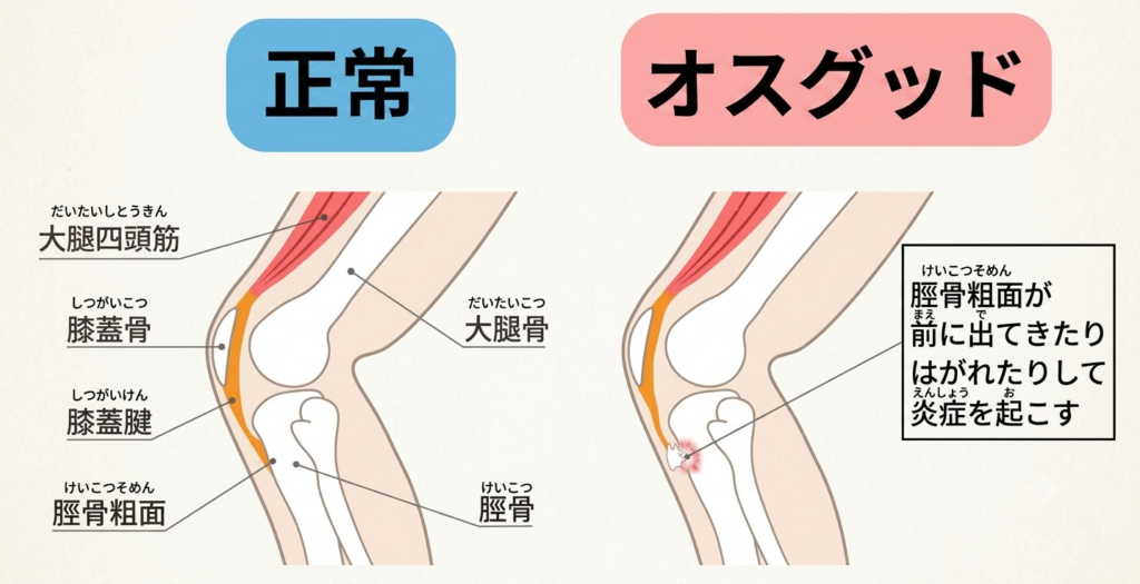 オスグッドの原因:大腿四頭筋の柔軟性の低下で繰り返しの牽引ストレス